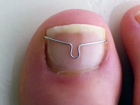 Nagelbeugel