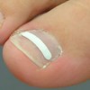 De nagelbeugel of orthonyxie